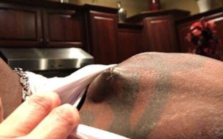 R-Truth Reveals Graphic Photos from Shoulder Surgery Repair