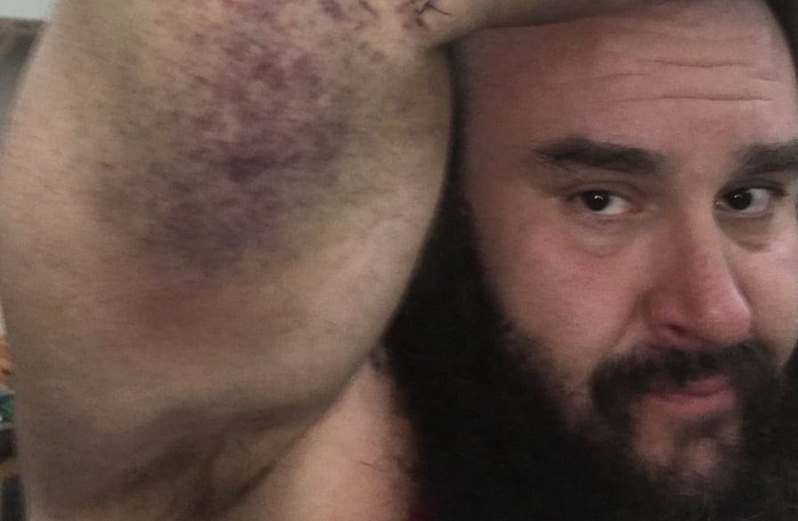 Braun Strowman’s Elbow Doesn’t Look Too Good Nine Days Prior To WWE TLC
