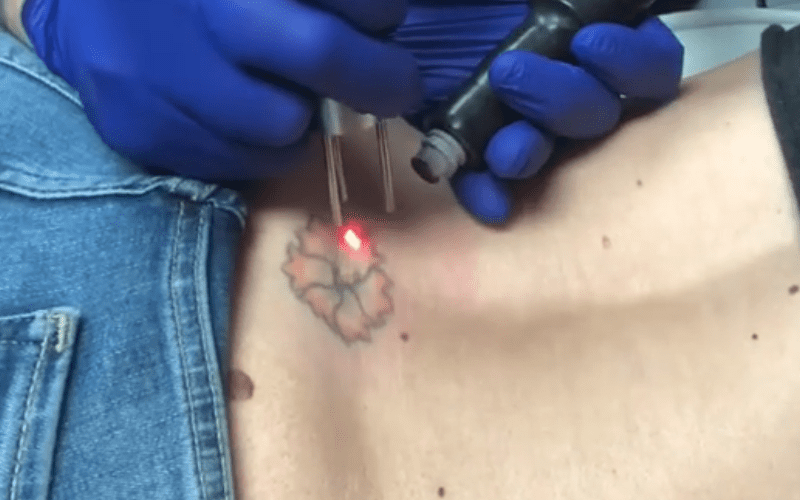 Watch Renee Young Get Rid Of Bad Tattoo