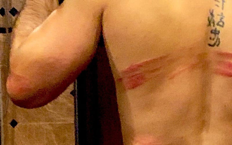 Seth Rollins Posts Photo Of Brutal Aftermath Following Dominik Mysterio’s Kendo Stick Shots On WWE RAW