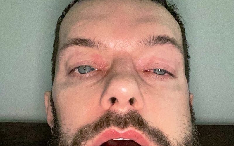 Finn Balor Shows Off SWOLLEN Face After Jaw Surgery