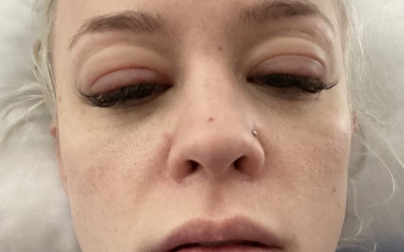 Penelope Ford Suffers Nasty Allergic Reaction To Fake Eyelashes