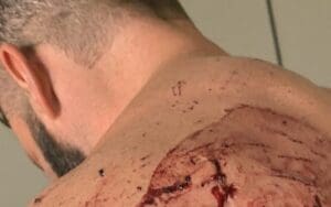NASTY Photos Of Matt Cardona’s Wounds After GCW Homecoming NASTY Photos Of Matt Cardona's Wounds After GCW Homecoming