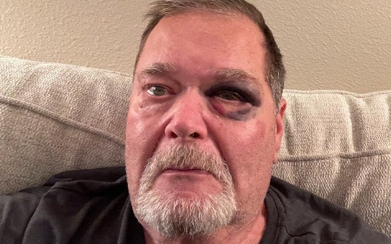 Jim Ross Gets A Black Eye After Suffering A Fall