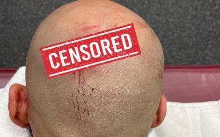 Ricochet Shows Off Nasty Stitches After WWE SmackDown Ricochet Shows Off Nasty Stitches After WWE SmackDown
