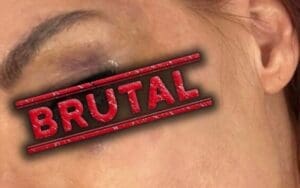 Lita Shows Off Brutal Black Eye After WrestleMania 39 Lita Shows Off Brutal Black Eye After WrestleMania 39