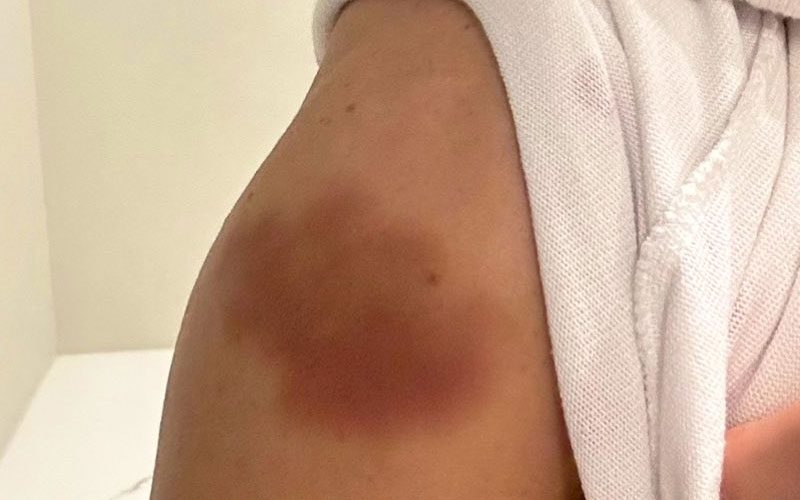 Natalya Shows Off Nasty Bruises After Brutal WWE RAW Match