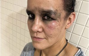 Shayna Baszler Shows Off Nasty Bruises After WWE SummerSlam Shayna Baszler Shows Off Nasty Bruises After WWE SummerSlam