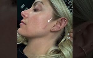 Alexa Bliss Displays Scar from Skin Cancer Treatment