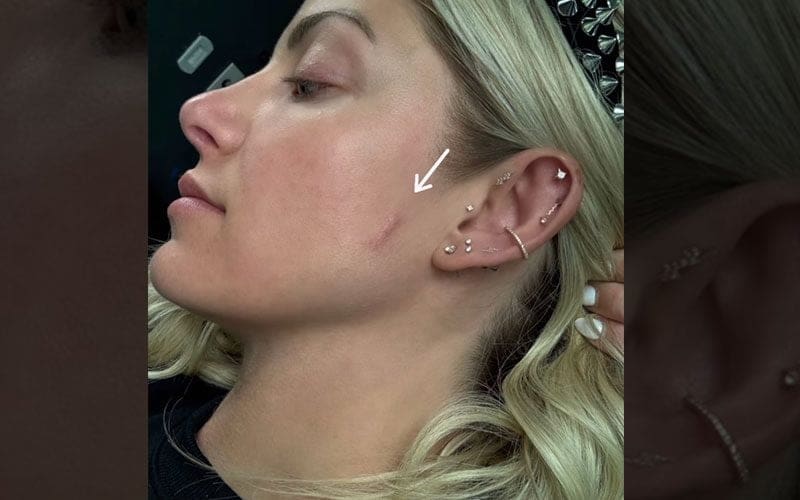 Alexa Bliss Displays Scar from Skin Cancer Treatment