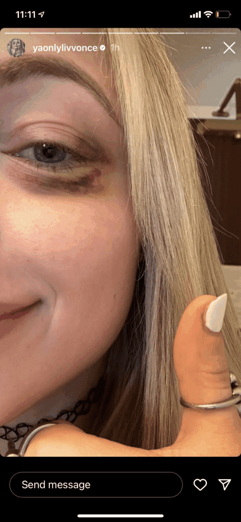 liv-morgan-sports-black-eye-after-competing-in-battle-royal-on-raw-38