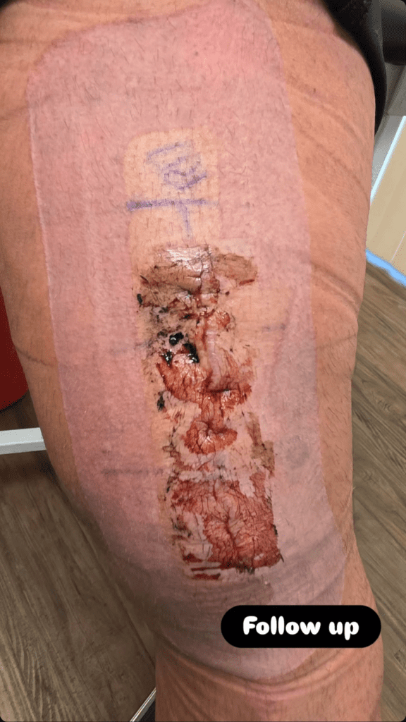 AEW Star Undergoes Knee Surgery During Absence from Television