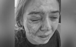 Eddie Guerrero’s Daughter Kaylie Suffered Gruesome Injury After Brutal Dog Attack